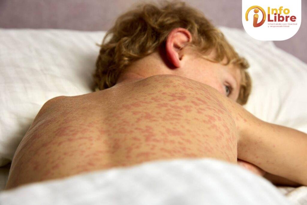 Sarampión en Caldas